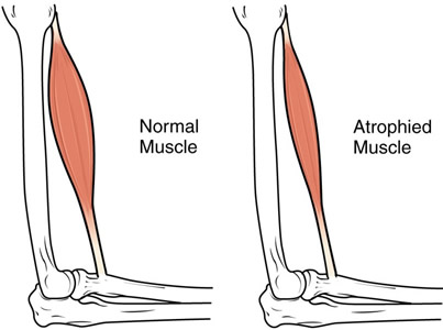 Regular and Atrophied Arm Muscle Comparison